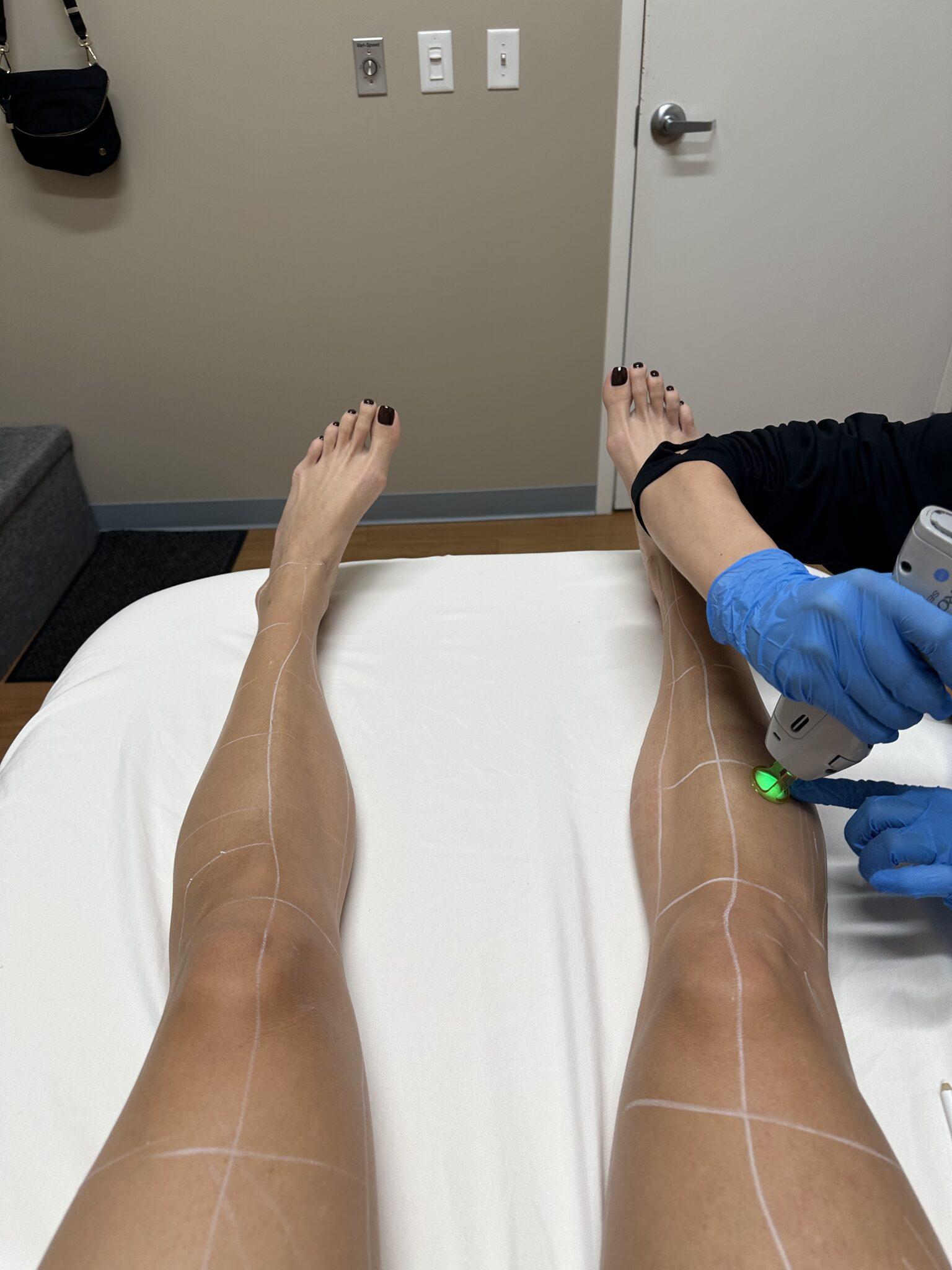 laser hair removal review milan laser 2 The Styled Press